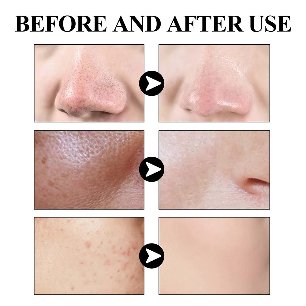 West Month Blackhead Removing Solid Mud Facial Mask